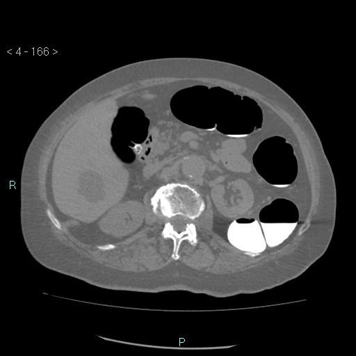 File:Colonic lipomas (Radiopaedia 49137-54244 Axial bone window 74).jpg
