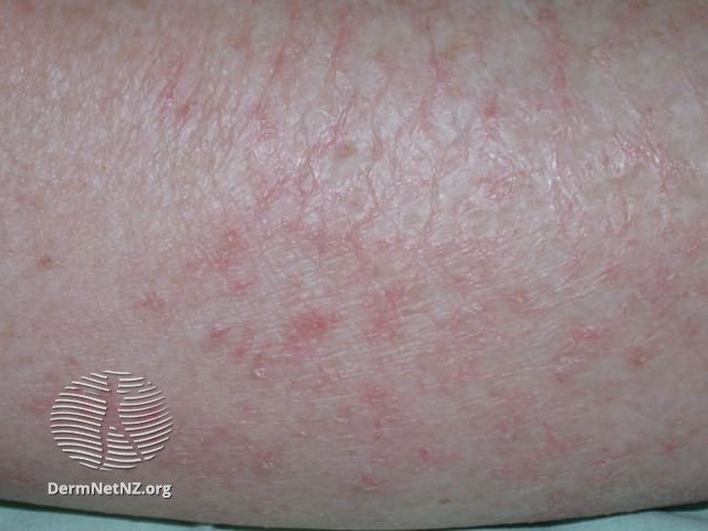 File:Eczema craquelé (DermNet NZ dermatitis-eczema-craquele1).jpg