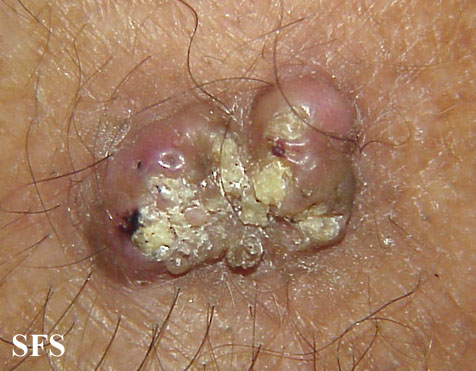 File:Keratoacanthoma (Dermatology Atlas 26).jpg