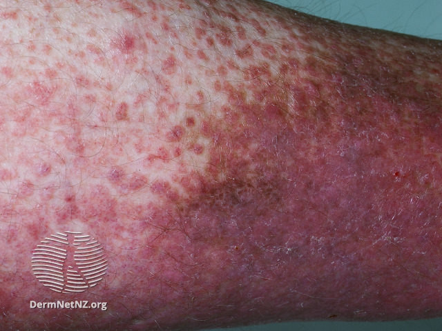 File:Lichen amyloidosis (DermNet NZ lichen-amyloidosis-20).jpg