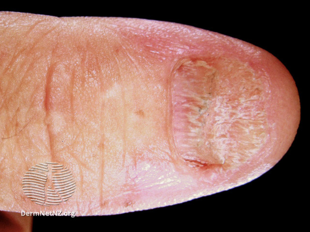 File:Lichen planus (DermNet NZ hair-nails-sweat-lichenplanus-nail1).jpg