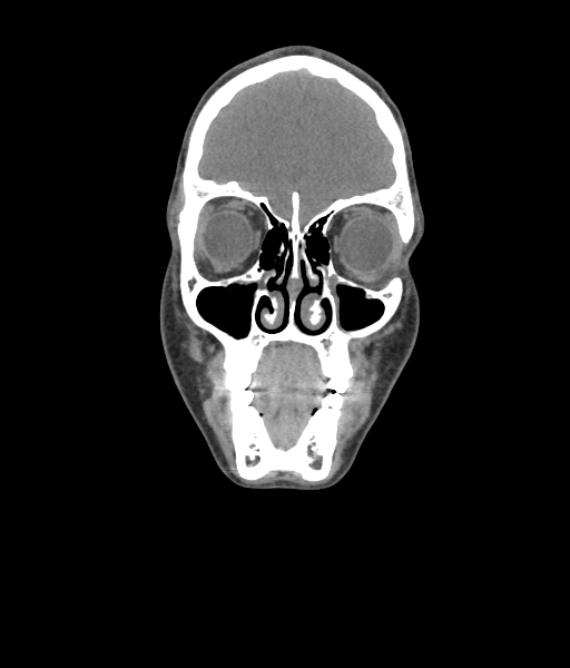 Nasal pyogenic granuloma (lobular capillary hemangioma) (Radiopaedia 85536-101244 Coronal non-contrast 67).jpg