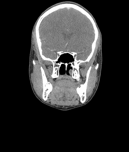 Nasal pyogenic granuloma (lobular capillary hemangioma) (Radiopaedia 85536-101244 D 57).jpg