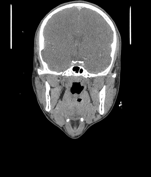 Nasal pyogenic granuloma (lobular capillary hemangioma) (Radiopaedia 85536-101244 D 60).jpg