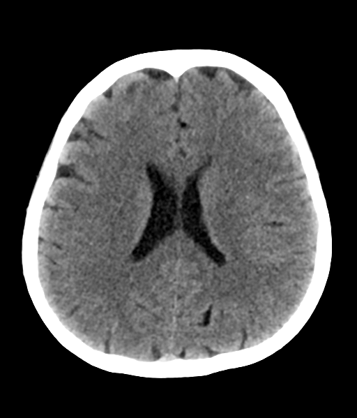 File:Nasopharyngeal carcinoma with cerebral abscess (Radiopaedia 43018-46275 Axial non-contrast 33).png