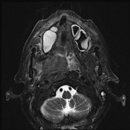 File:Nasopharyngeal carcinoma with skull base invasion (Radiopaedia 59258-66600 D 22).jpg