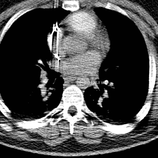File:Neck CT angiogram (intraosseous vascular access) (Radiopaedia 55481-61945 Axial Monitoring 12).jpg