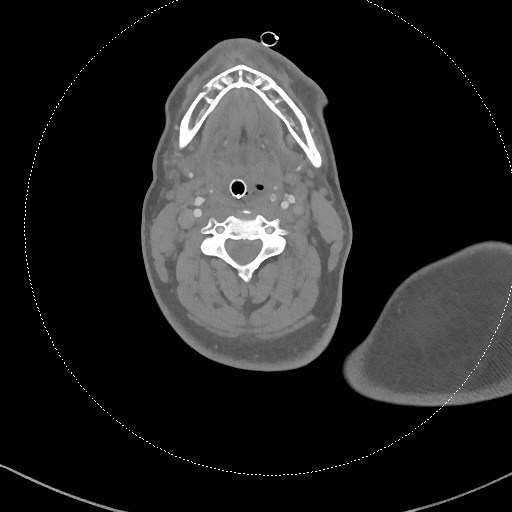 Neck CT angiogram (intraosseous vascular access) (Radiopaedia 55481-61945 B 195).jpg