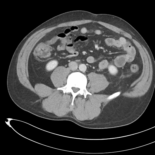 File:Necrotizing pancreatitis with acute necrotic collections (Radiopaedia 38829-41012 B 48).png
