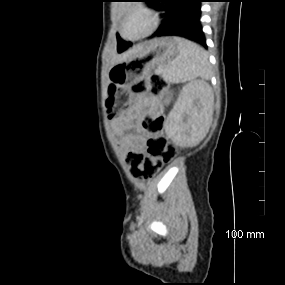 File:Neonatal neuroblastoma (Radiopaedia 56651-63438 C 26).jpg