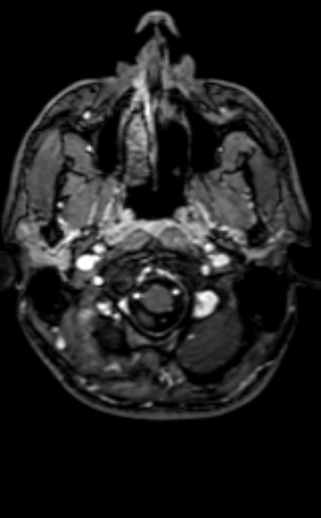 Neuro-Behçet disease (Radiopaedia 90112-107294 Axial T1 C+ 195).jpg