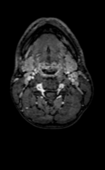 Neuro-Behçet disease (Radiopaedia 90112-107294 Axial T1 C+ 254).jpg