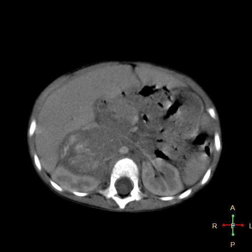 File:Neuroblastoma (Radiopaedia 24751-25016 D 15).jpg