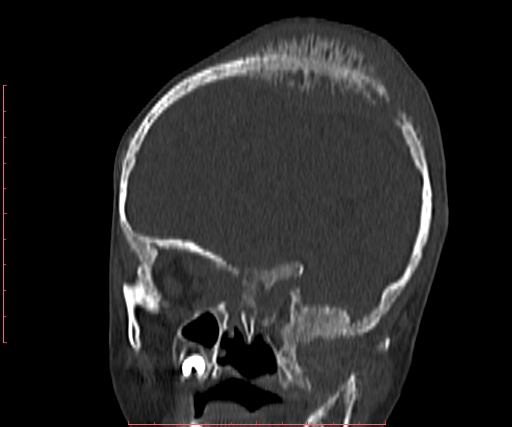 File:Neuroblastoma skull metastasis (Radiopaedia 56053-62683 Coronal bone window 13).jpg