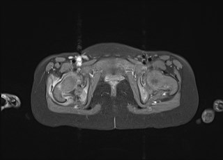 File:Neuroblastoma with bone metastases (Radiopaedia 67080-76414 Axial T1 C+ fat sat 46).jpg