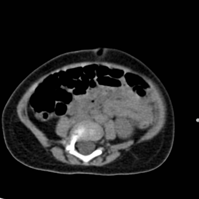 Neuroblastoma with skull metastases (Radiopaedia 30326-30960 Axial non-contrast 39).jpg
