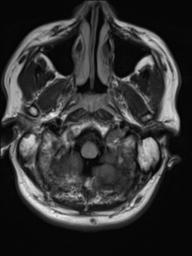 File:Neurofibromatosis type 2 (Radiopaedia 44936-48838 Axial FLAIR 2).png