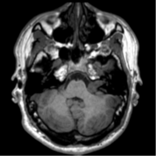 File:Neurofibromatosis type 2 (Radiopaedia 44936-48838 Axial T1 26).png