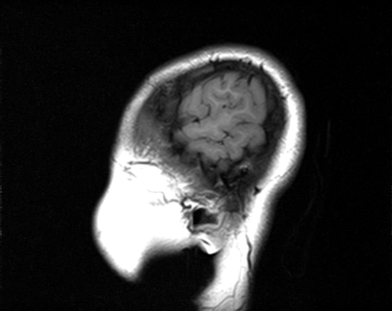 File:Neurofibromatosis type 2 (Radiopaedia 66211-75401 Sagittal T1 2).jpg