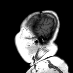 File:Neurofibromatosis type 2 (Radiopaedia 8713-9518 Sagittal T1 1).jpg
