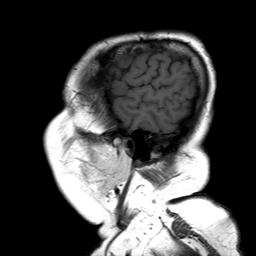 File:Neurofibromatosis type 2 (Radiopaedia 8713-9518 Sagittal T1 2).jpg
