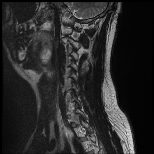File:Neurofibromatosis type 2 (spinal manifestations) (Radiopaedia 53943-60070 Sagittal T2 2).png