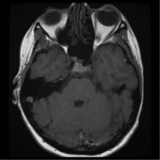 File:Neurofibromatosis type 2 - bilateral acoustic neuromata (Radiopaedia 40060-42566 Axial T1 9).png