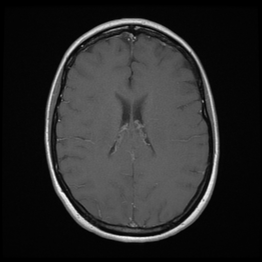 File:Neurofibromatosis type 2 - bilateral acoustic neuromata (Radiopaedia 40060-42566 Axial T1 C+ 13).png