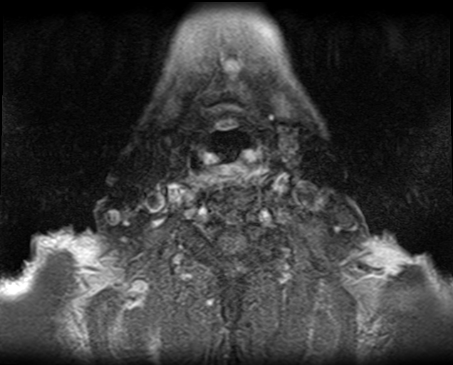 File:Non-Hodgkin lymphoma - parotid gland (Radiopaedia 71531-81890 Axial T1 C+ fat sat 2).jpg