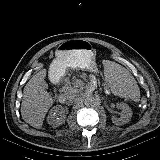 File:Non Hodgkin lymphoma in a patient with ankylosing spondylitis (Radiopaedia 84323-99621 Axial non-contrast 36).jpg