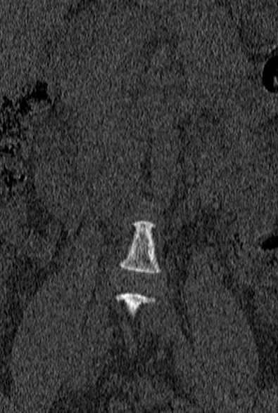 File:Normal CT lumbar spine (Radiopaedia 53981-60118 Coronal bone window 2).jpg