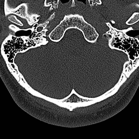 Normal CT of the cervical spine (Radiopaedia 53322-59305 Axial bone window 19).jpg