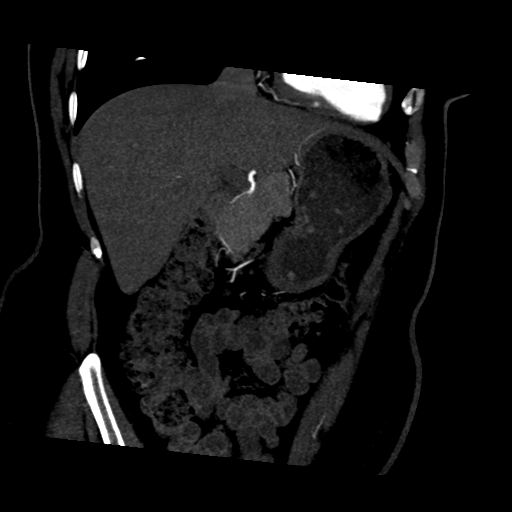 File:Normal CT renal artery angiogram (Radiopaedia 38727-40889 D 4).png