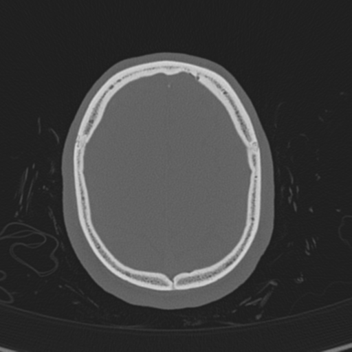 Normal CT skull (Radiopaedia 40798-43459 A 130).png