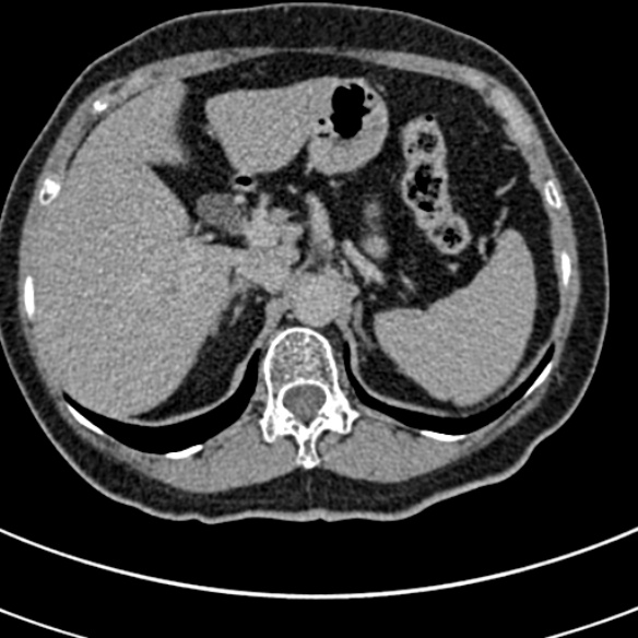 File:Normal CT split bolus study of the renal tract (Radiopaedia 48631-53634 Axial split bolus 15).jpg