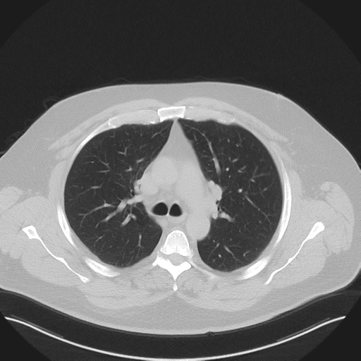 Normal HRCT (Radiopaedia 40797-43458 Axial lung window 22).png