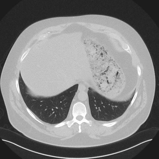 Normal HRCT (Radiopaedia 40797-43458 Axial lung window 47).png