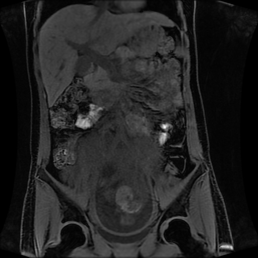 Normal MRI abdomen in pregnancy (Radiopaedia 88001-104541 M 68).jpg