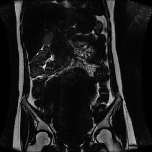 Normal MRI abdomen in pregnancy (Radiopaedia 88001-104541 N 66).jpg