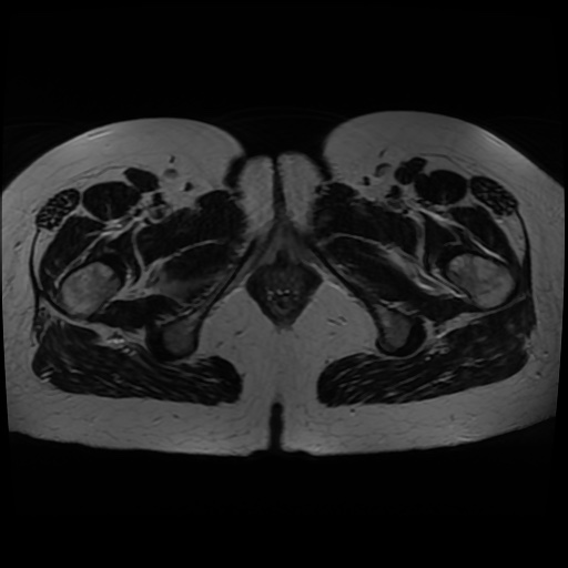 Normal MRI abdomen in pregnancy (Radiopaedia 88005-104548 Axial T2 50).jpg