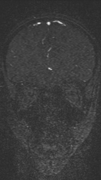 Normal MRI brain with MRV- teenager (Radiopaedia 49425-54553 Coronal MRV 81).jpg