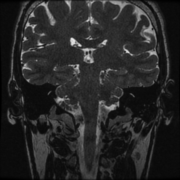 Normal MRI petrous (Radiopaedia 91317-108949 Coronal T2 67).jpg
