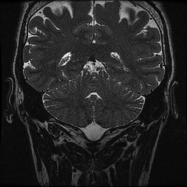 Normal MRI petrous (Radiopaedia 91317-108949 Coronal T2 94).jpg