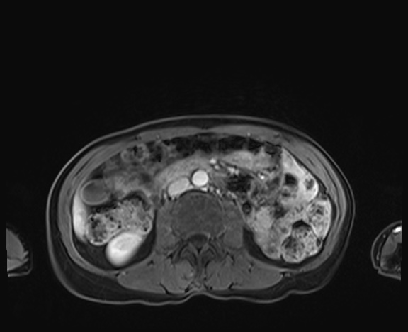 Normal adrenal glands MRI (Radiopaedia 82017-96004 K 51).jpg