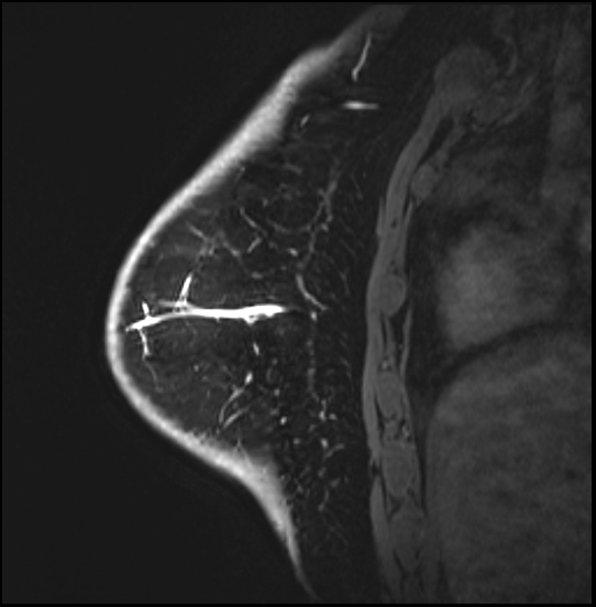 Normal breast MRI - dense breasts (Radiopaedia 80454-93850 I 144).jpg