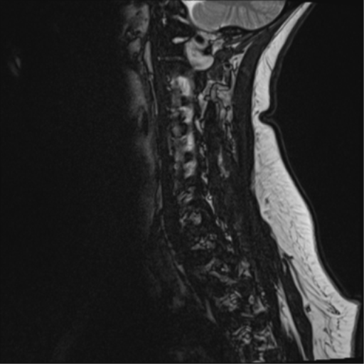 File:Normal cervical spine MRI (including Dixon) (Radiopaedia 42762-45925 Dixon- opposed phase 4).png