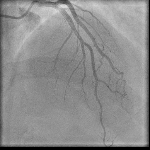 Normal coronary angiogram (DSA) (Radiopaedia 63081-71571 E 55).jpg