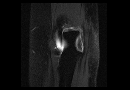 File:Normal elbow arthrograms (Radiopaedia 75550-86805 Coronal T1 fat sat 4).jpg