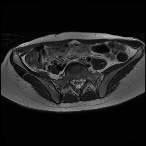 File:Normal female pelvis MRI (retroverted uterus) (Radiopaedia 61832-69933 Axial T2 6).jpg