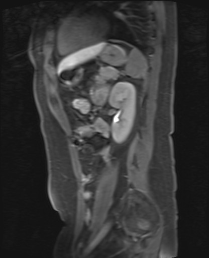 File:Normal hepatobiliary phase liver MRI (Radiopaedia 58968-66230 C 55).jpg